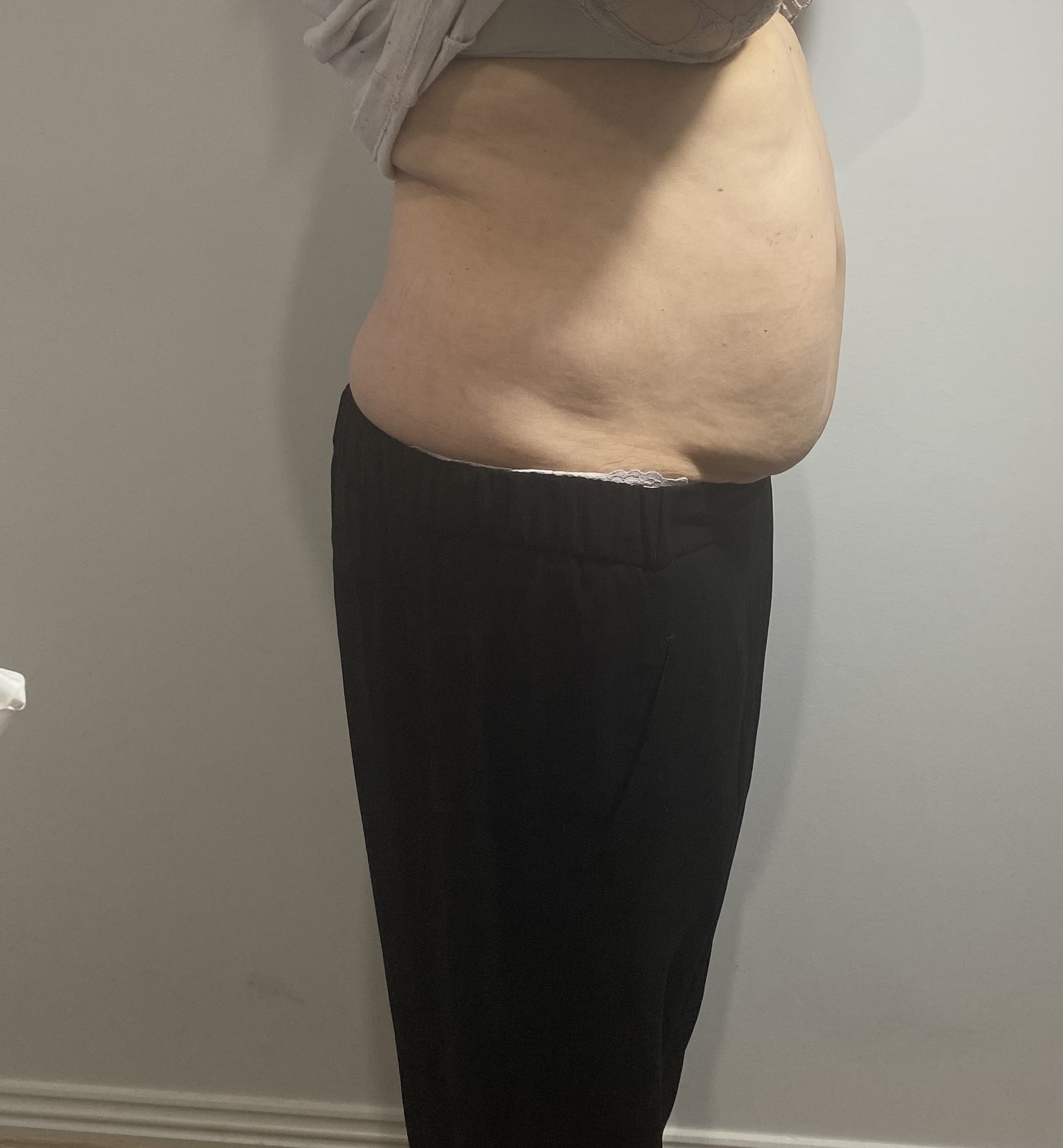 Cryolipolysis Fat Freeze Before